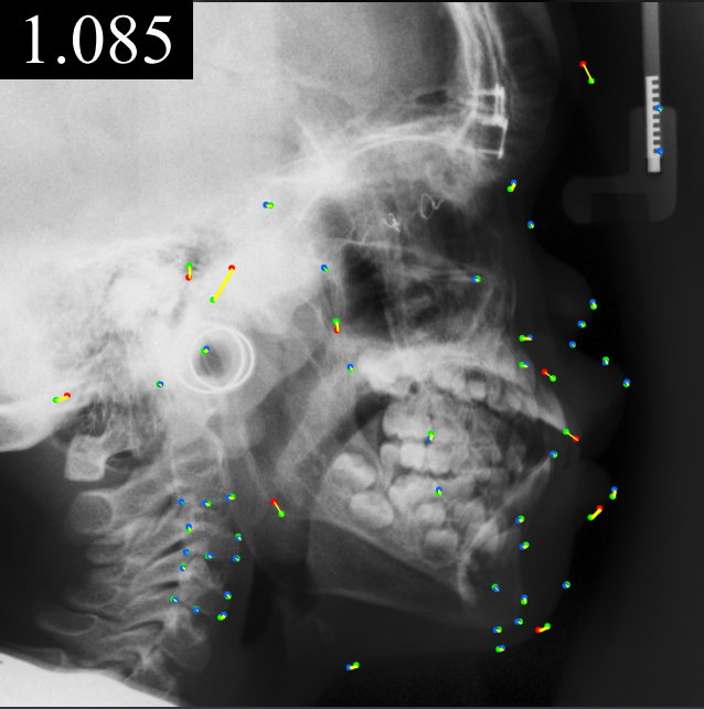 An X-ray scan of a scull and neck, on the scan there are small blue, red and green dots with green and yellow lines that connect them.